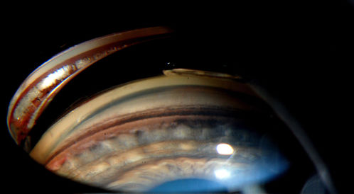Gonioscopy- Pigmentary Glaucoma Suspect
Patient with no family history of glaucoma, comes in with elevated IOP. During Gonioscopy exam. brown pigment overlying the trabecular meshwork. Also, trans-illumination defects on the iris.
