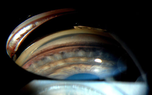 Gonioscopy- Pigmentary Glaucoma Suspect
Patient with no family history of glaucoma, comes in with elevated IOP. During Gonioscopy exam. brown pigment overlying the trabecular meshwork. Also, trans-illumination defects on the iris.
