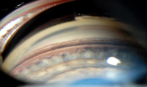 Gonioscopy- Pigmentary Glaucoma Suspect
Patient with no family history of glaucoma, comes in with elevated IOP. During Gonioscopy exam. brown pigment overlying the trabecular meshwork. Also, trans-illumination defects on the iris.
