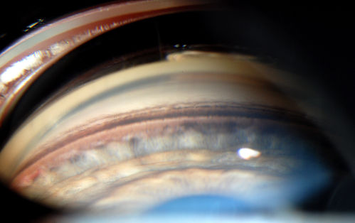 Gonioscopy- Pigmentary Glaucoma Suspect
Patient with no family history of glaucoma, comes in with elevated IOP. During Gonioscopy exam. brown pigment overlying the trabecular meshwork. Also, trans-illumination defects on the iris.
