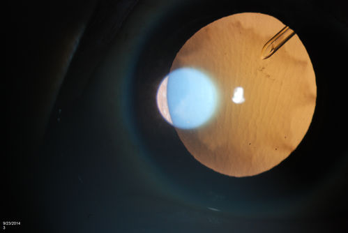 Flower Cataract
Patient with ahmed tube and flower cataract
Keywords: september2014