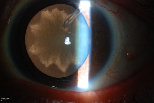 Flower Cataract
Patient with ahmed tube and flower cataract
