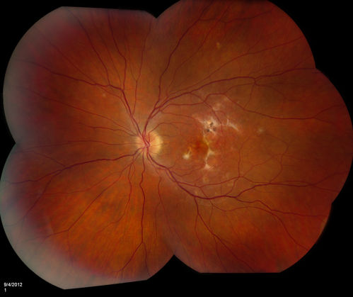 Multifocal Choroidits Vitiligo ( Voght- Kayanagi-Harada Syndrome )
36-year old patient with decreased vision in both eyes with fatigue for over a year. VA 20/25-OD, 20/60 -OS. Patient was treated with Avastin and oral prednisone. 
