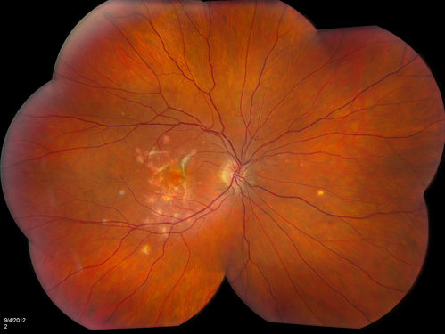 Multifocal Choroidits Vitiligo ( Voght- Kayanagi-Harada Syndrome )
36-year old patient with decreased vision in both eyes with fatigue for over a year. VA 20/25-OD, 20/60 -OS. Patient was treated with Avastin and oral prednisone. 
