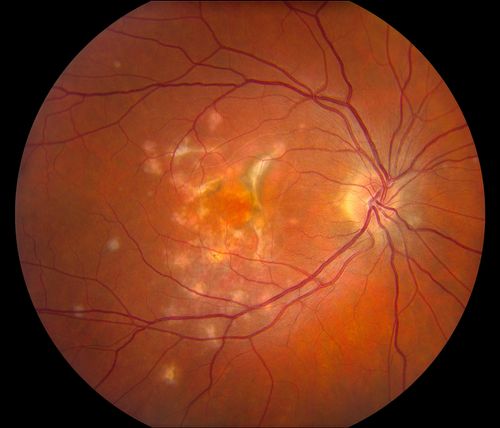 Multifocal Choroidits Vitiligo ( Voght- Kayanagi-Harada Syndrome )
36-year old patient with decreased vision in both eyes with fatigue for over a year. VA 20/25-OD, 20/60 -OS. Patient was treated with Avastin and oral prednisone. 
