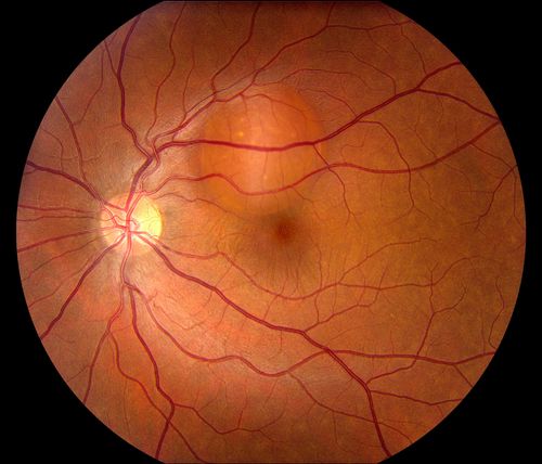 Retinal Pigment Epithelial Detachment with no Sub-Retinal Fluid...
A 38-year old male who comes in with blurred vision in the left eye. VA is 20/30. Notices a defect inferior of his central vision. Did an Fluorescence Angiogram to determine an RPE with no sub retinal fluid. Also OCT confirms. Patient was injected with Avastin.
Mots-clés: september2012