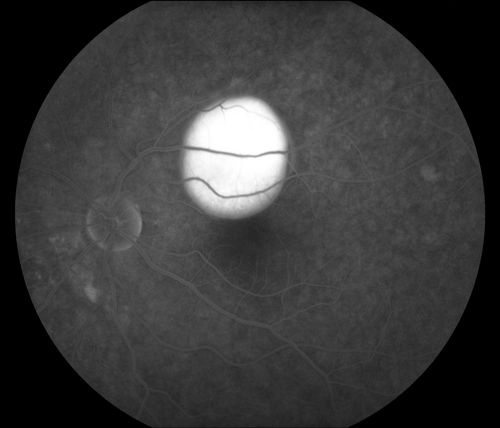 Retinal Pigment Epithelial Detachment with no Sub-Retinal Fluid...
A 38-year old male who comes in with blurred vision in the left eye. VA is 20/30. Notices a defect inferior of his central vision. Did an Fluorescence Angiogram to determine an RPE with no sub retinal fluid. Also OCT confirms. Patient was injected with Avastin.
