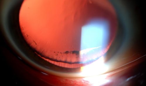 Pigmentary Glaucoma, Zonules visible Inferiorly...
Young gentleman with pigmentary glaucoma. Heavy pigment lining trabecular meshwork with Goinoscopy. Crisp image of the zonules. 
