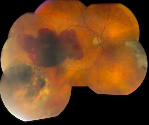 Retinal Hemorrhage
Patient has history of Macular Degeneration (WET). Also has had vitrectomy in the left eye for a retinal detachment. Chief complaint was a spot in vision, right eye. Patient's VA was hand motion in the right eye. Retinal Hemorrhage was present. Avastin Injection was carried out and patient will have a follow up in one month.
