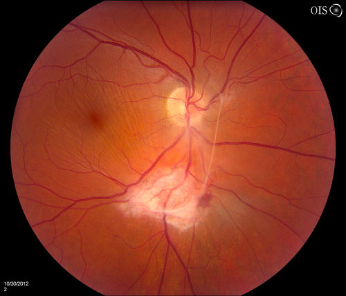 Toxoplasmosis - Vitreoretinal Traction
A 28-year old male who noticed an upper partial visual loss to his right eye for about 2-weeks. Diagnosed with retinitis and was put on acyclovir. Patient received second opinion due to culture of aqueous humor which was then diagnosed as Toxoplasmosis. VA was 20/25 in the right eye. Pt has been followed after for the past 7-months. 
Keywords: november2012