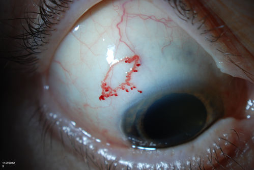 Conjunctival Vascular Anomaly
Patient presents a vascular pattern of blood vessels @ 10 o'clock of the superior-temporal quadrant of the right eye. Patient has had flare ups with anterior scleritis in the past  which is controlled by Methotrexate. Patient's VA is currently 20/40 with PH 20/30, right eye.  

