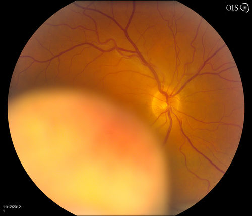 Choroidal Melanoma
Young male patient notice a visual field defect in the right eye. Patient's VA was 20/60 with no improvement with pinhole. No history of cancer. Patient will be followed up in one week to discuss surgery. 
