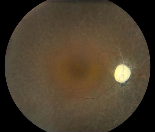 Retinal Pigmintosa
28-year old female with no light perception in the right eye. 
Keywords: november2012
