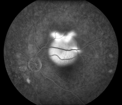 Central Serous Retinopathy
Young male who comes in for follow up on CSR in the left eye. Patient had focal laser treatment 1-month ago. There are still spots of leaking and proceeded with another focal laser treatment. Notice the top of the hyperfluorescent area.
Keywords: november2012