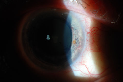 Rubeosis Iridis
Patient presents with Rubeosis Iridis in the right eye due to neovascular glaucoma. VA is 20/40 in the right eye. Will follow up in 3-months.
