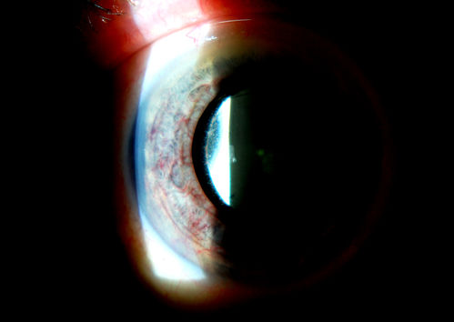 Rubeosis Iridis
Patient presents with Rubeosis Iridis in the right eye due to neovascular glaucoma. VA is 20/40 in the right eye. Will follow up in 3-months.
