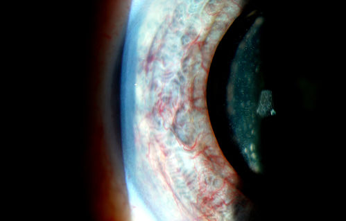 Rubeosis Iridis
Patient presents with Rubeosis Iridis in the right eye due to neovascular glaucoma. VA is 20/40 in the right eye. Will follow up in 3-months.
