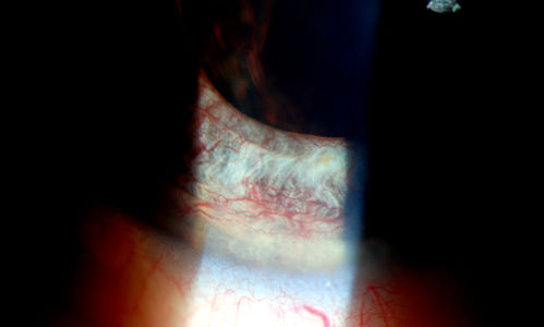 Rubeosis Iridis
Patient presents with Rubeosis Iridis in the right eye due to neovascular glaucoma. VA is 20/40 in the right eye. Will follow up in 3-months.
