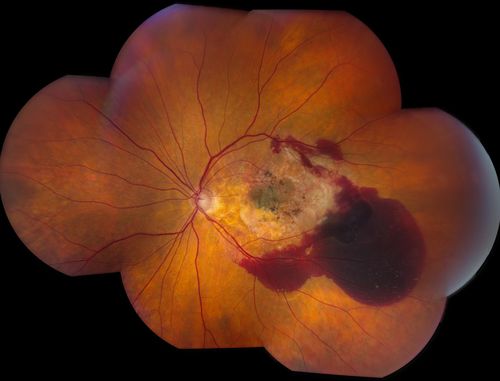 Macular Degeneration with Hemorrhage
Patient comes in for follow up exam for wet AMD. Fundus photography reveals retinal hemorrhage temporally to the macula. Patient was not treated. Wait to see if the blood will absorb on its own. 
Keywords: december2012