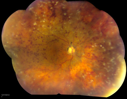 Central Retinal Vein Occlusion with Macular Edema and Retinal Hemorrhages 
Female patient of 86-years of age presents a central retinal vein occlusion with macular edema in the right eye. Patient's VA was 20/70 in the right eye. Proceeded with laser treatment to the right eye.
