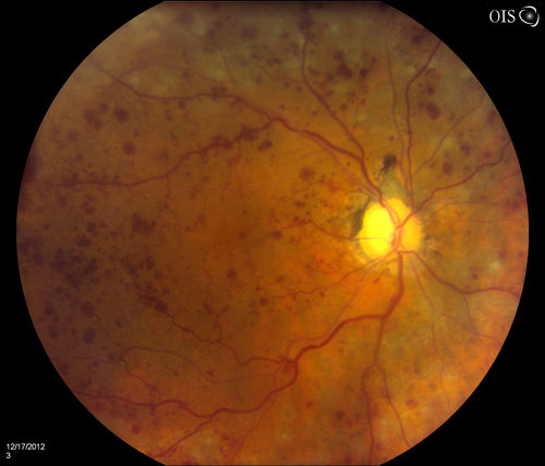 Central Retinal Vein Occlusion with Macular Edema and Retinal Hemorrhages 
Female patient of 86-years of age presents a central retinal vein occlusion with macular edema in the right eye. Patient's VA was 20/70 in the right eye. Proceeded with laser treatment to the right eye.
