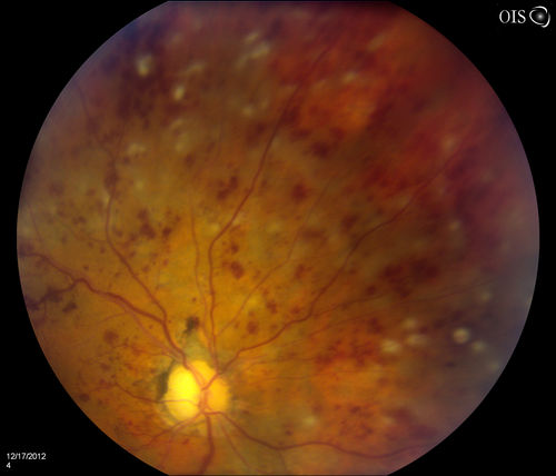 Central Retinal Vein Occlusion with Macular Edema and Retinal Hemorrhages 
Female patient of 86-years of age presents a central retinal vein occlusion with macular edema in the right eye. Patient's VA was 20/70 in the right eye. Proceeded with laser treatment to the right eye.
