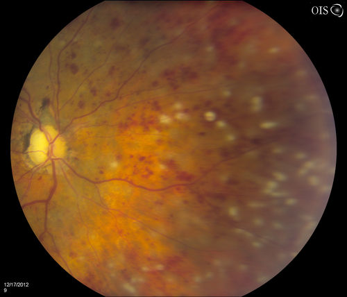 Central Retinal Vein Occlusion with Macular Edema and Retinal Hemorrhages 
Female patient of 86-years of age presents a central retinal vein occlusion with macular edema in the right eye. Patient's VA was 20/70 in the right eye. Proceeded with laser treatment to the right eye.
