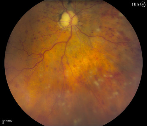 Central Retinal Vein Occlusion with Macular Edema and Retinal Hemorrhages 
Female patient of 86-years of age presents a central retinal vein occlusion with macular edema in the right eye. Patient's VA was 20/70 in the right eye. Proceeded with laser treatment to the right eye.
