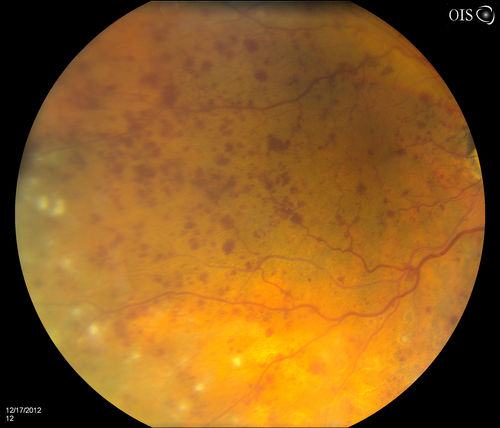 Central Retinal Vein Occlusion with Macular Edema and Retinal Hemorrhages 
Female patient of 86-years of age presents a central retinal vein occlusion with macular edema in the right eye. Patient's VA was 20/70 in the right eye. Proceeded with laser treatment to the right eye.
