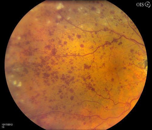 Central Retinal Vein Occlusion with Macular Edema and Retinal Hemorrhages 
Female patient of 86-years of age presents a central retinal vein occlusion with macular edema in the right eye. Patient's VA was 20/70 in the right eye. Proceeded with laser treatment to the right eye.
