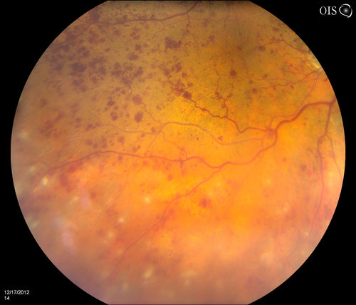 Central Retinal Vein Occlusion with Macular Edema and Retinal Hemorrhages 
Female patient of 86-years of age presents a central retinal vein occlusion with macular edema in the right eye. Patient's VA was 20/70 in the right eye. Proceeded with laser treatment to the right eye.
