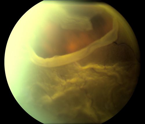 Large Retinal Tear.
Pt. with lattice degeneration comes in with Retinal Detachment with a large retinal tear at 12 o'clock in the right eye. VA was 20/400. Macula was detached as well. Patient underwent surgery to reattach the retina. 
