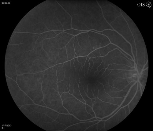 Central Serous Retinopathy
Patient comes in with blurred vision. Patient also had a lung transplant. VA was 20/150 with pinhole correction to 20/60 in the right eye. Fundus exam in the right eye shows a great amount of sub retinal fluid over the macula. Will monitor to see if it goes away on its own, if not then will consider laser treatment. 
