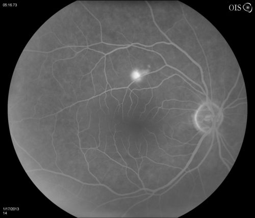 Central Serous Retinopathy
Patient comes in with blurred vision. Patient also had a lung transplant. VA was 20/150 with pinhole correction to 20/60 in the right eye. Fundus exam in the right eye shows a great amount of sub retinal fluid over the macula. Will monitor to see if it goes away on its own, if not then will consider laser treatment. 
