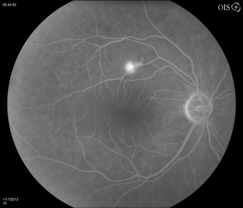 Central Serous Retinopathy
Patient comes in with blurred vision. Patient also had a lung transplant. VA was 20/150 with pinhole correction to 20/60 in the right eye. Fundus exam in the right eye shows a great amount of sub retinal fluid over the macula. Will monitor to see if it goes away on its own, if not then will consider laser treatment. 
