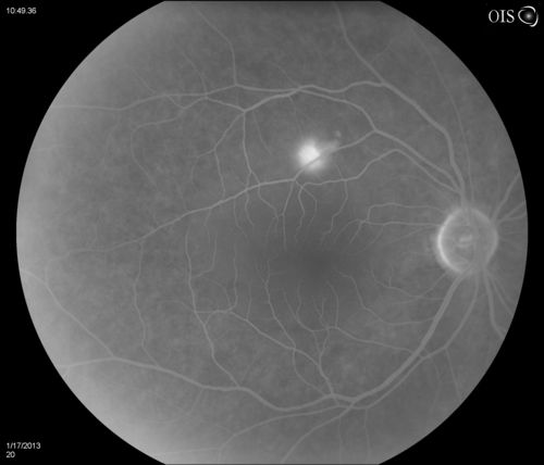 Central Serous Retinopathy
Patient comes in with blurred vision. Patient also had a lung transplant. VA was 20/150 with pinhole correction to 20/60 in the right eye. Fundus exam in the right eye shows a great amount of sub retinal fluid over the macula. Will monitor to see if it goes away on its own, if not then will consider laser treatment. 
