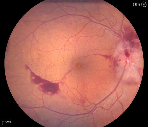 Diabetic Papillitis
Patient is about to undergo surgery for CNS Aneurysm. Patient woke up with little spots which never cleared up. Patients VA was 20/30-OD and 20/40-OS.  Both eyes appeared to have disc edema with hemorrhages in the right eye. Ordered a CT of the brain to make sure the aneurysm didn't ruptured.
