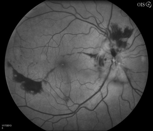 Diabetic Papillitis
Patient is about to undergo surgery for CNS Aneurysm. Patient woke up with little spots which never cleared up. Patients VA was 20/30-OD and 20/40-OS.  Both eyes appeared to have disc edema with hemorrhages in the right eye. Ordered a CT of the brain to make sure the aneurysm didn't ruptured.
