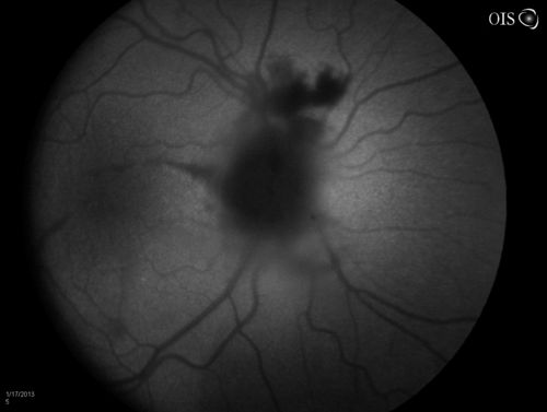 Diabetic Papillitis
Patient is about to undergo surgery for CNS Aneurysm. Patient woke up with little spots which never cleared up. Patients VA was 20/30-OD and 20/40-OS.  Both eyes appeared to have disc edema with hemorrhages in the right eye. Ordered a CT of the brain to make sure the aneurysm didn't ruptured.
