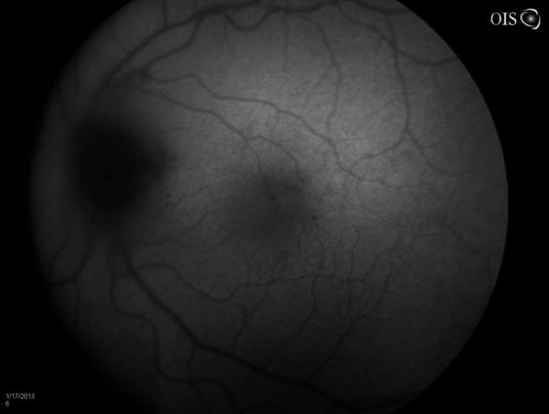 Diabetic Papillitis
Patient is about to undergo surgery for CNS Aneurysm. Patient woke up with little spots which never cleared up. Patients VA was 20/30-OD and 20/40-OS.  Both eyes appeared to have disc edema with hemorrhages in the right eye. Ordered a CT of the brain to make sure the aneurysm didn't ruptured.
