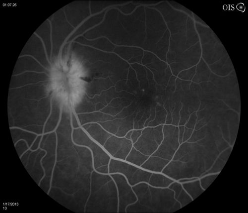 Diabetic Papillitis
Patient is about to undergo surgery for CNS Aneurysm. Patient woke up with little spots which never cleared up. Patients VA was 20/30-OD and 20/40-OS.  Both eyes appeared to have disc edema with hemorrhages in the right eye. Ordered a CT of the brain to make sure the aneurysm didn't ruptured.
