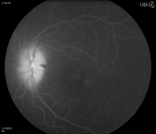 Diabetic Papillitis
Patient is about to undergo surgery for CNS Aneurysm. Patient woke up with little spots which never cleared up. Patients VA was 20/30-OD and 20/40-OS.  Both eyes appeared to have disc edema with hemorrhages in the right eye. Ordered a CT of the brain to make sure the aneurysm didn't ruptured.
