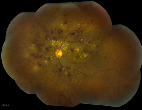 Combined Artery and Vein Occlusion
Patient comes in with decreased vision in both eyes. VA 20/200-OD, 20/60-OS. Fundus exam shows great amount of macular edema due to artery and vein occlusions. There is some neovascularization on the optic nerve in the right eye. Patient was treated with Eylea Injection in the left eye today and will return for Eylea Injection in the right eye. 
