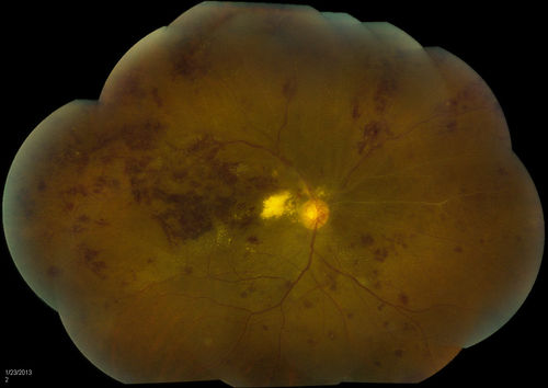 Combined Artery and Vein Occlusion
Patient comes in with decreased vision in both eyes. VA 20/200-OD, 20/60-OS. Fundus exam shows great amount of macular edema due to artery and vein occlusions. There is some neovascularization on the optic nerve in the right eye. Patient was treated with Eylea Injection in the left eye today and will return for Eylea Injection in the right eye.
