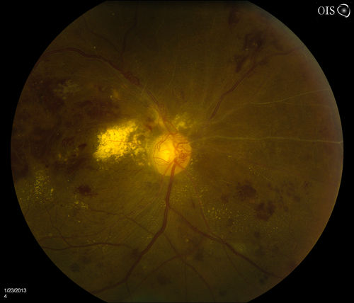 Combined Artery and Vein Occlusion
Patient comes in with decreased vision in both eyes. VA 20/200-OD, 20/60-OS. Fundus exam shows great amount of macular edema due to artery and vein occlusions. There is some neovascularization on the optic nerve in the right eye. Patient was treated with Eylea Injection in the left eye today and will return for Eylea Injection in the right eye.
