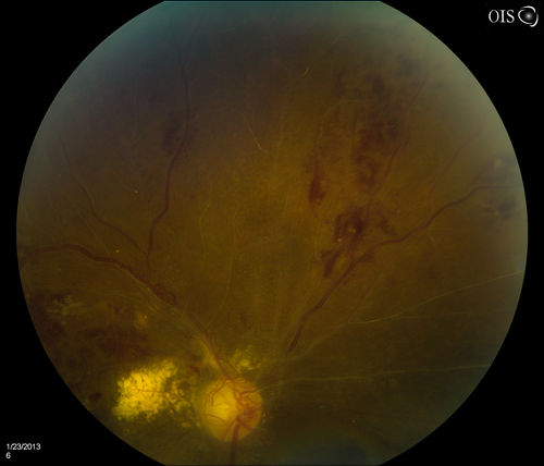 Combined Artery and Vein Occlusion
Patient comes in with decreased vision in both eyes. VA 20/200-OD, 20/60-OS. Fundus exam shows great amount of macular edema due to artery and vein occlusions. There is some neovascularization on the optic nerve in the right eye. Patient was treated with Eylea Injection in the left eye today and will return for Eylea Injection in the right eye.
