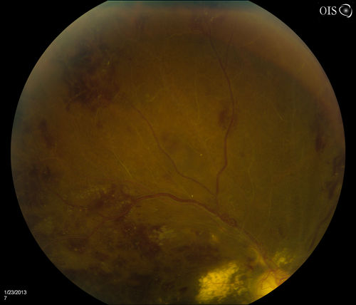 Combined Artery and Vein Occlusion
Patient comes in with decreased vision in both eyes. VA 20/200-OD, 20/60-OS. Fundus exam shows great amount of macular edema due to artery and vein occlusions. There is some neovascularization on the optic nerve in the right eye. Patient was treated with Eylea Injection in the left eye today and will return for Eylea Injection in the right eye.
