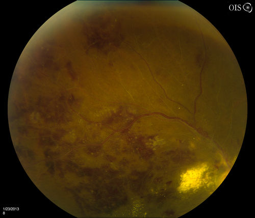 Combined Artery and Vein Occlusion
Patient comes in with decreased vision in both eyes. VA 20/200-OD, 20/60-OS. Fundus exam shows great amount of macular edema due to artery and vein occlusions. There is some neovascularization on the optic nerve in the right eye. Patient was treated with Eylea Injection in the left eye today and will return for Eylea Injection in the right eye.
