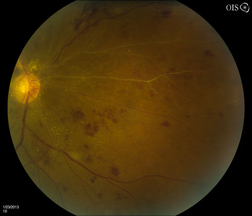 Combined Artery and Vein Occlusion
Patient comes in with decreased vision in both eyes. VA 20/200-OD, 20/60-OS. Fundus exam shows great amount of macular edema due to artery and vein occlusions. There is some neovascularization on the optic nerve in the right eye. Patient was treated with Eylea Injection in the left eye today and will return for Eylea Injection in the right eye.
