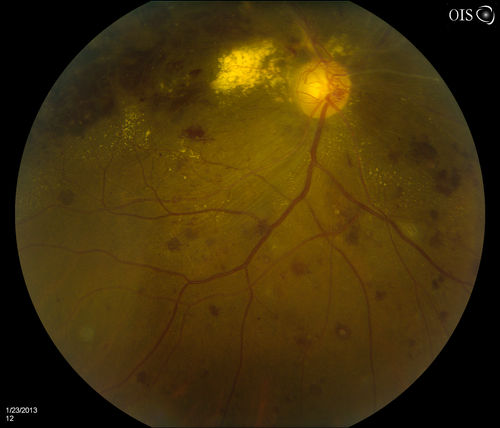 Combined Artery and Vein Occlusion
Patient comes in with decreased vision in both eyes. VA 20/200-OD, 20/60-OS. Fundus exam shows great amount of macular edema due to artery and vein occlusions. There is some neovascularization on the optic nerve in the right eye. Patient was treated with Eylea Injection in the left eye today and will return for Eylea Injection in the right eye.
